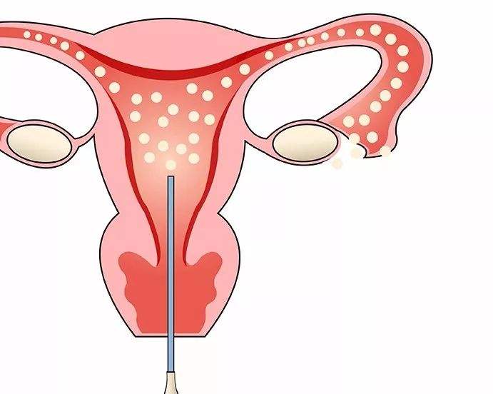 多囊卵巢综合症初期症状表现有哪些