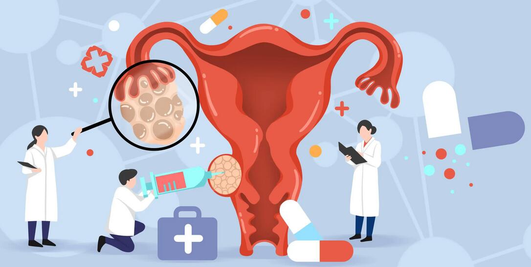 卵巢癌的预防方法有几种