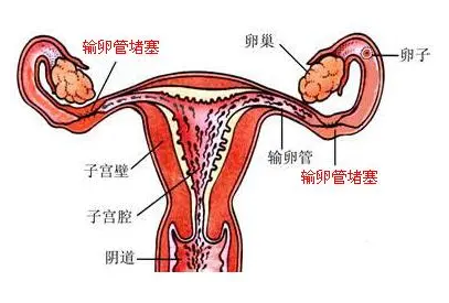 输卵管堵塞有什么样症状