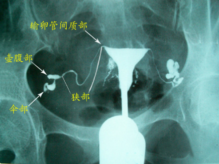 什么时候做妇科b超检查最好