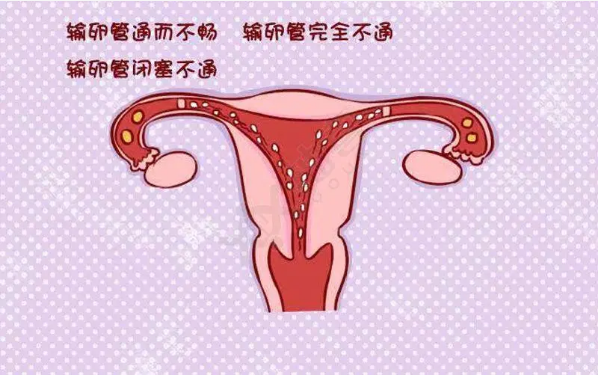 输卵管疾病对女性生育能力的影响