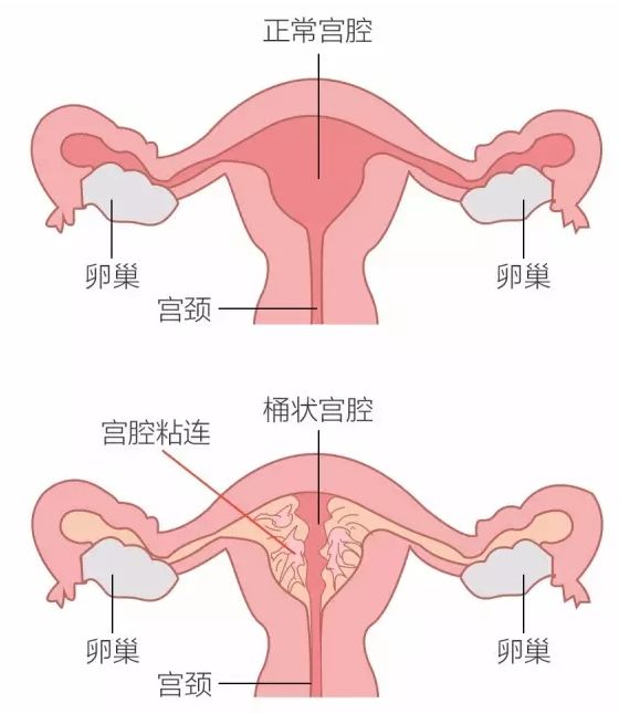 子宫内膜离家出走,成了不孕不育的头号杀手!子宫内膜异位怎么治疗?