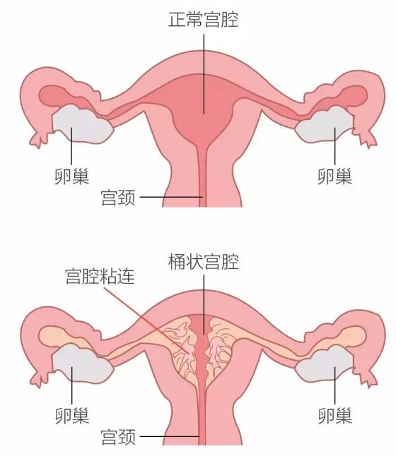 子宫内膜离家出走，成了不孕不育的头号杀手！子宫内膜异位怎么治疗？