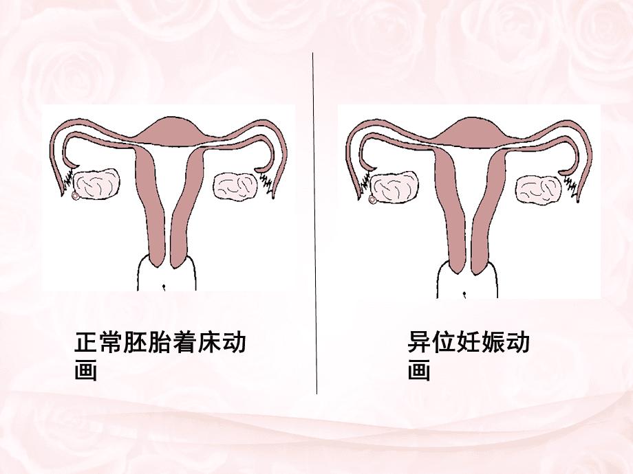 多囊怀孕后第几个月容易流产?多囊卵巢怀孕之后容易流产吗?