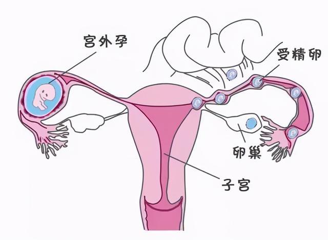 有多囊的人自然怀孕了以后是不是就没事了？