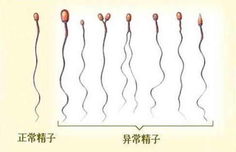 48岁男人精子怀孕的孩子有影响吗?