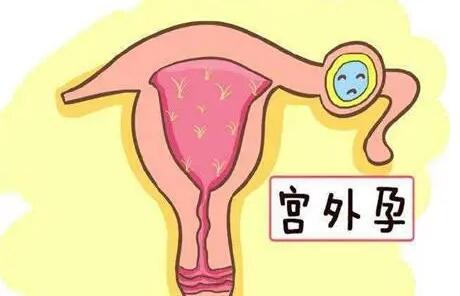 宫外孕的早期症状有哪些?宫外孕是肚子哪个部位疼？