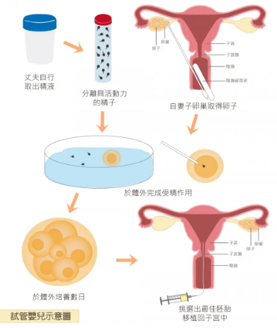 什么样的人适合试管婴儿？