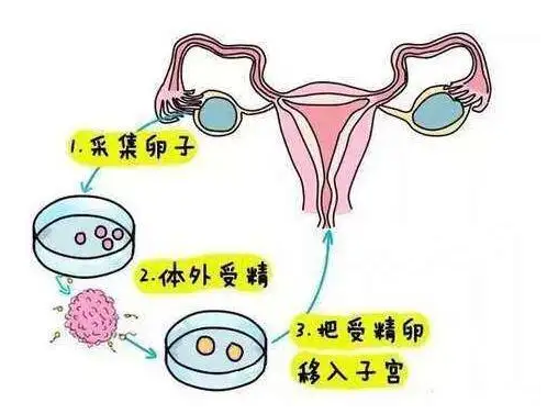 试管婴儿助孕常用的促排卵方案
