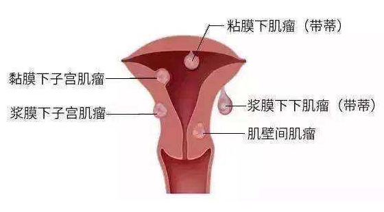 女性输卵管问题有四种治疗方法