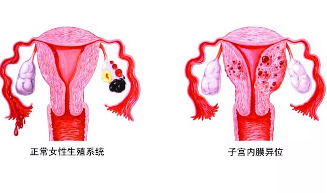 子宫内膜异位症有什么症状?
